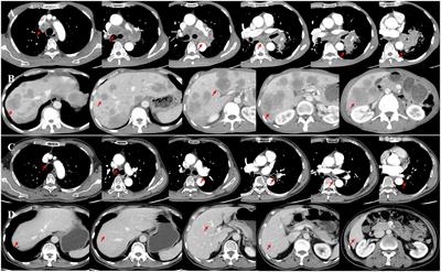 Local radiotherapy in extensive-stage small-cell lung cancer sustainably boosts the clinical benefit of first-line immunotherapy: a case report